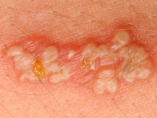 Вот так выглядят герпетические пузырьки на коже... Вот так выглядят герпетические пузырьки на коже...