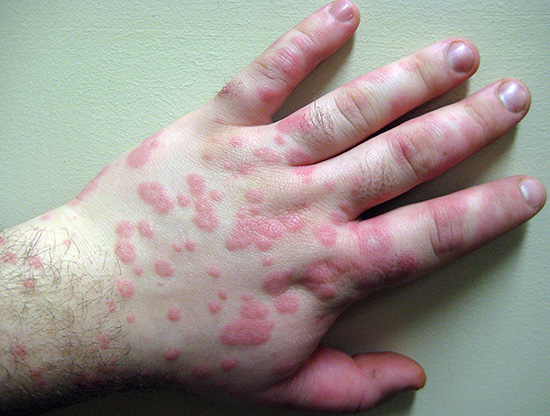 При аллергических реакциях характер высыпаний совсем иной, нежели чем при герпесе. При аллергических реакциях характер высыпаний совсем иной, нежели чем при герпесе.