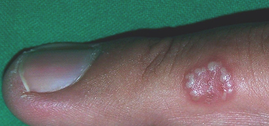 Заболевание, локализованное на руках, редко проявляет себя в тяжелой форме. Заболевание, локализованное на руках, редко проявляет себя в тяжелой форме.