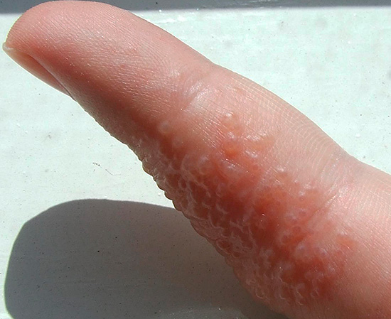 Герпетические высыпания на пальце руки Герпетические высыпания на пальце руки