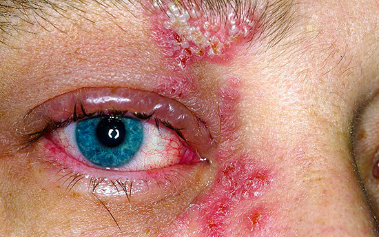 Если тереть глаза пораженными герпесом пальцами, то можно инфицировать не только кожу вокруг глаз, но и их слизистые оболочки. Если тереть глаза пораженными герпесом пальцами, то можно инфицировать не только кожу вокруг глаз, но и их слизистые оболочки.