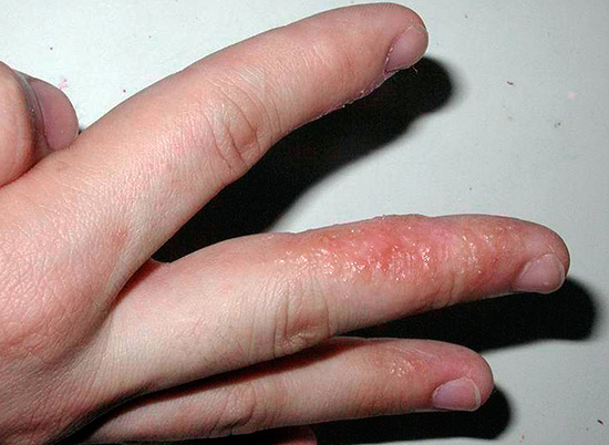 Обычно какого-то специального лечения при появлении язвочек на руках не требуется. Обычно какого-то специального лечения при появлении язвочек на руках не требуется.