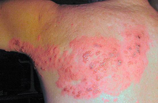 Иногда опоясывающий лишай может распространиться и на кожу рук. Иногда опоясывающий лишай может распространиться и на кожу рук.