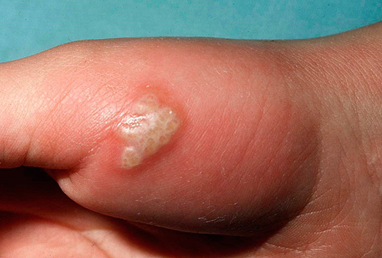 Герпетические папулы Герпетические папулы