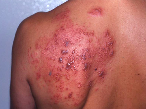 Разберемся, почему на спине может появиться герпетическая сыпь... Разберемся, почему на спине может появиться герпетическая сыпь...