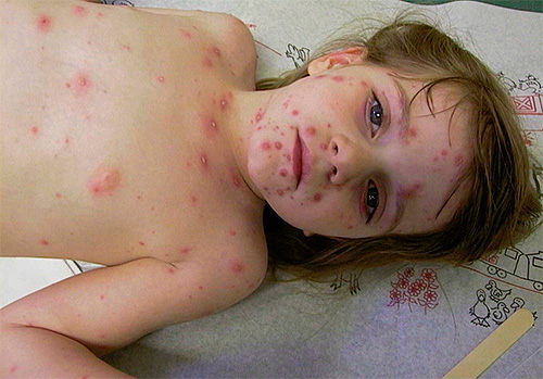 Ветрянка у ребенка также вызывается вирусом герпеса (3 типа) Ветрянка у ребенка также вызывается вирусом герпеса (3 типа)