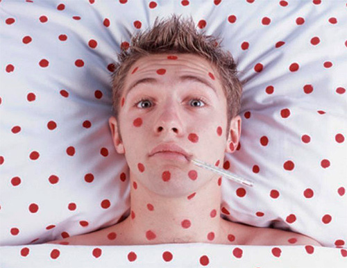 Ветряная оспа обычно переносится взрослыми гораздо сложнее, чем детьми. Ветряная оспа обычно переносится взрослыми гораздо сложнее, чем детьми