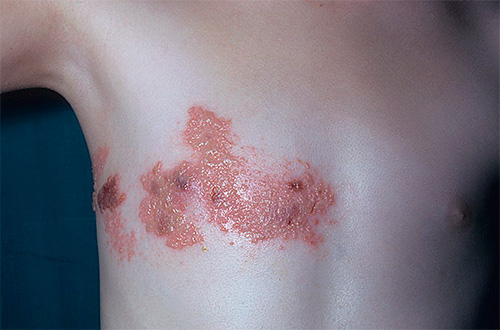 Опоясывающий лишай на теле ребенка Опоясывающий лишай на теле ребенка