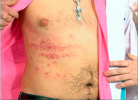 Появление язвочек на теле могут вызывать разные виды герпесвирусов... Появление язвочек на теле могут вызывать разные виды герпесвирусов...