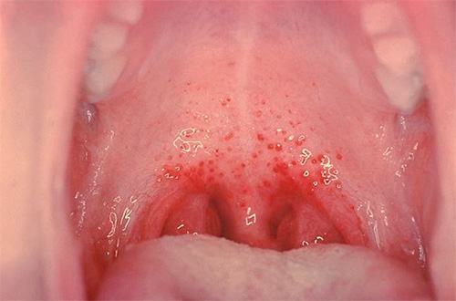 В горле у ребенка появляются характерные высыпания в виде пузырьков... В горле у ребенка появляются характерные высыпания в виде пузырьков...