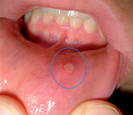 Язвочка на десне Язвочка на десне