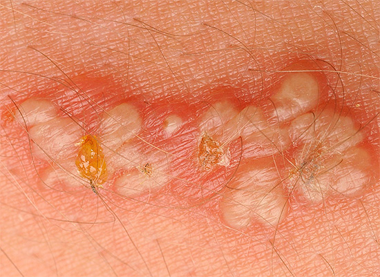 Существует несколько типов инфекций, вызываемых герпесвирусами... Существует несколько типов инфекций, вызываемых герпесвирусами...