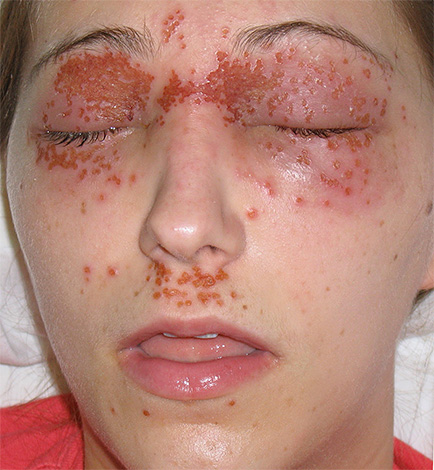 Наиболее тяжело реактивация вируса протекает у людей с иммунодефицитами. Наиболее тяжело реактивация вируса протекает у людей с иммунодефицитами.