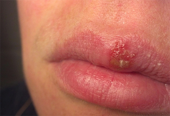 На фотографии показан пример так называемой простуды на губах. На фотографии показан пример так называемой простуды на губах.