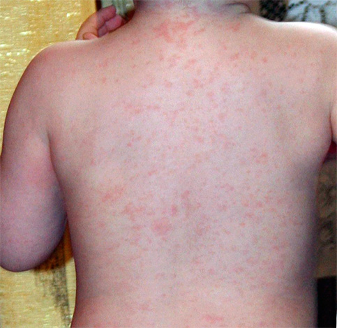 Так выглядит внезапная экзантема у ребенка Так выглядит внезапная экзантема у ребенка