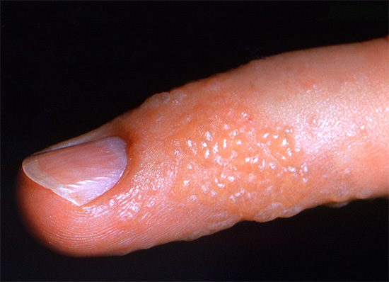 Герпетический панариций Герпетический панариций