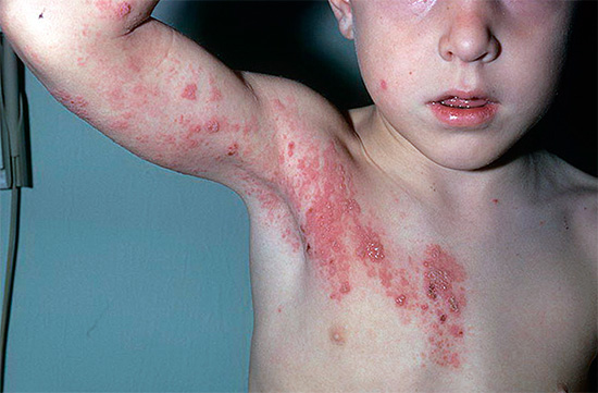 Рецидив герпетической инфекции, вызываемой вирусом герпеса 3 типа - опоясывающий лишай. Рецидив герпетической инфекции, вызываемой вирусом герпеса 3 типа - опоясывающий лишай.