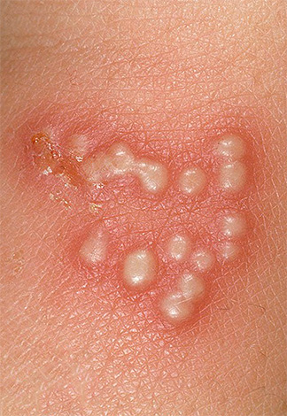 На фото показаны характерные для герпеса пузырьки на коже. На фото показаны характерные для герпеса пузырьки на коже.