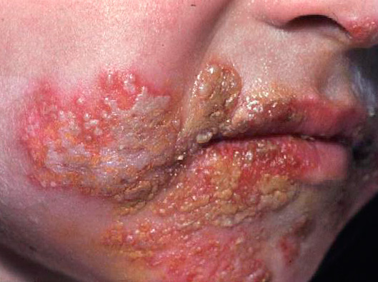 При тяжелых симптомах заболевания следует обращаться за лечением к врачу... При тяжелых симптомах заболевания следует обращаться за лечением к врачу...