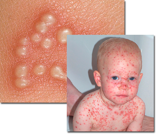 Выясняем, какие инфекции, вызываемые герпесвирусами, встречаются в детском возрасте... Выясняем, какие инфекции, вызываемые герпесвирусами, встречаются в детском возрасте...