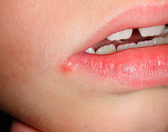 При ослаблении иммунитета инфекция может реактивироваться в организме, что через некоторое время проявится соответствующими симптомами. При ослаблении иммунитета инфекция может реактивироваться в организме, что через некоторое время проявится соответствующими симптомами.