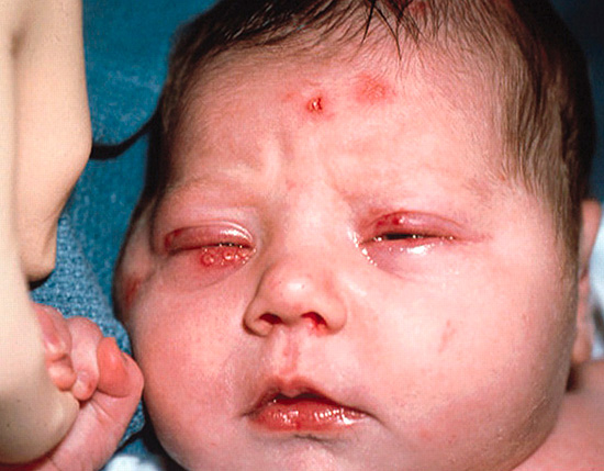 При прохождении по родовым путям ребенок может заразиться герпесом от матери, больной генитальной формой инфекции. При прохождении по родовым путям ребенок может заразиться герпесом от матери, больной генитальной формой инфекции.