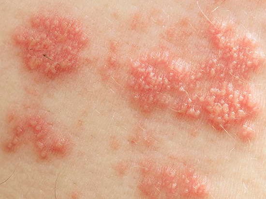 Так выглядят характерные герпетические высыпания на коже, вызванные вирусом herpes simplex. Так выглядят характерные герпетические высыпания на коже, вызванные вирусом herpes simplex.