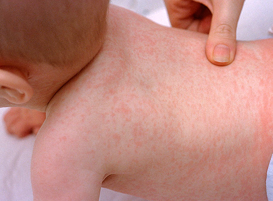 Розеола Розеола