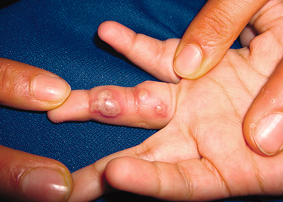 Герпетический панариций (герпес на пальцах). Герпетический панариций (герпес на пальцах).