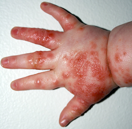 Герпетические высыпания могут локализоваться не только на губах, но и, например, на руках, ногах или теле ребенка. Герпетические высыпания могут локализоваться не только на губах, но и, например, на руках, ногах или теле ребенка.