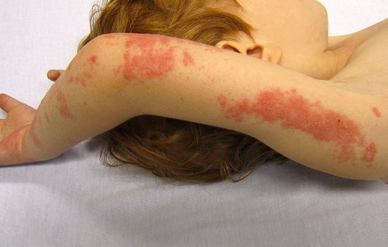 Опоясывающий лишай на руке ребенка Опоясывающий лишай на руке ребенка