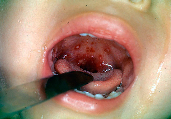 Так называемая герпангина в действительности не является герпетической (ее вызывает кишечный вирус Коксаки). Так называемая герпангина в действительности не является герпетической (ее вызывает кишечный вирус Коксаки).