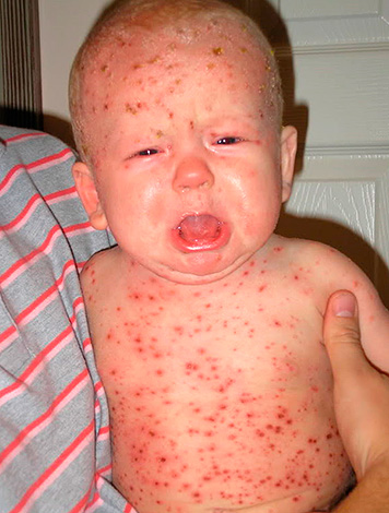 Ветрянка (ветряная оспа). Ветрянка (ветряная оспа).