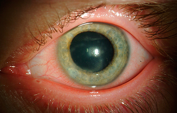 При аутоиммунном ответе организма тяжесть течения болезни может значительно усиливаться, вплоть до практически полной потери зрения. При аутоиммунном ответе организма тяжесть течения болезни может значительно усиливаться, вплоть до практически полной потери зрения.