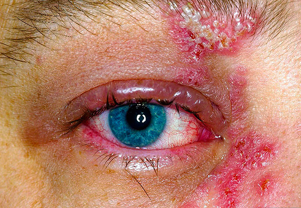 Заболевание непосредственно связано с заражением организма вирусом простого герпеса. Заболевание непосредственно связано с заражением организма вирусом простого герпеса.