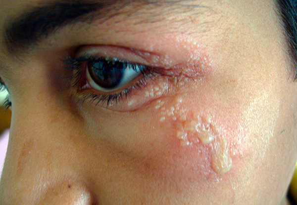 Герпетические высыпания могут поражать не только глаза, но и значительную площадь вокруг них. Герпетические высыпания могут поражать не только глаза, но и значительную площадь вокруг них.