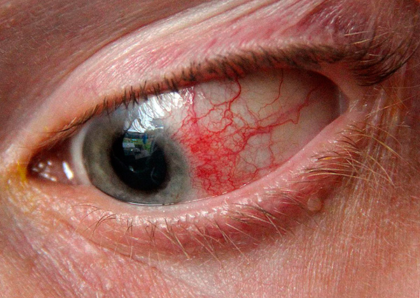 Герпетический конъюнктивит. Герпетический конъюнктивит