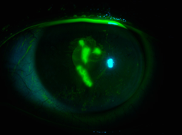 Дендритные (древовидные) язвы на роговице глаза при герпетическом кератите. Дендритные (древовидные) язвы на роговице глаза при герпетическом кератите.