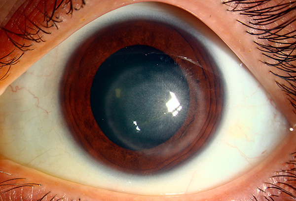 В более тяжелых случаях формируется дисковидная язва роговицы. В более тяжелых случаях формируется дисковидная язва роговицы.