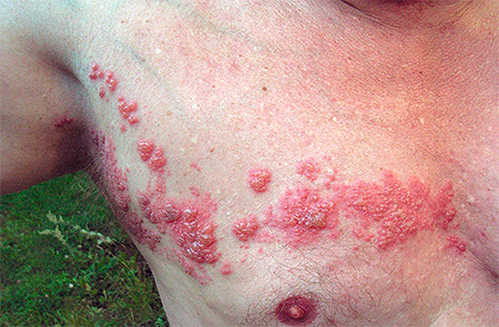 Поговорим про опоясывающий лишай... Поговорим про гопоясывающий лишай...