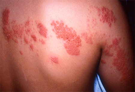 При заболевании изъязвления кожных покровов располагаются по ходу пораженных нервов При заболевании изъязвления кожных покровов располагаются по ходу пораженных нервов