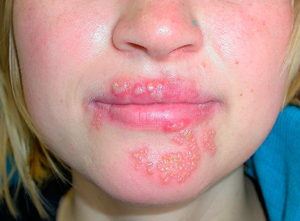 Знакомимся с особенностями так называемого хронического герпеса - почему он возникает очень часто и как лечиться в таких случаях... Знакомимся с особенностями так называемого хронического герпеса - почему он возникает очень часто и как лечиться в таких случаях...