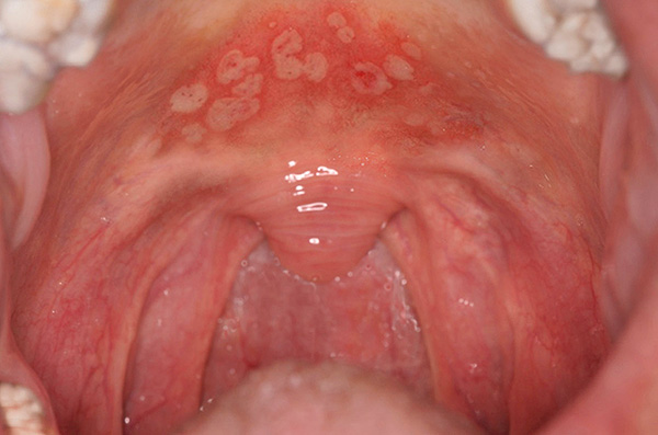 Часто рецидивировать может и герпетический стоматит... Часто рецидивировать может и герпетический стоматит...