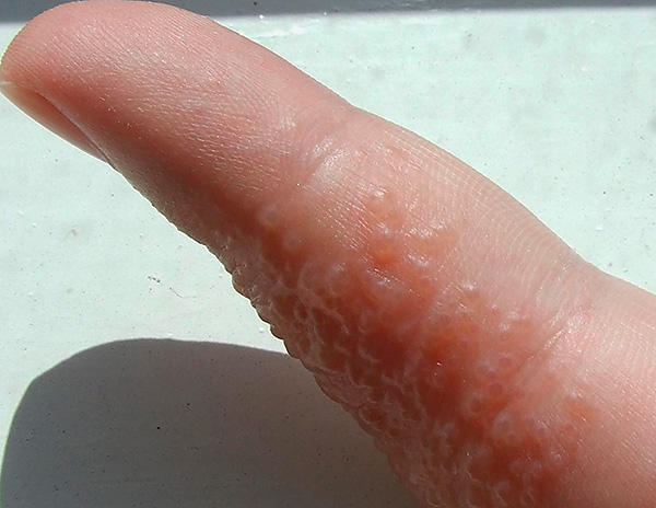 Рецидивы инфекции могут проявляться и на пальцах (так называемый герпетический панариций). Рецидивы инфекции могут проявляться и на пальцах (так называемый герпетический панариций).