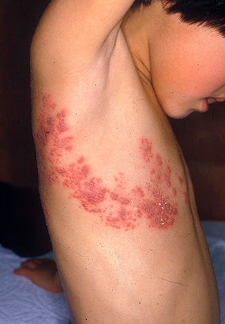 При рецидивах опоясывающего лишая высыпания располагаются чаще всего вокруг туловища, как бы опоясывая его. При рецидивах опоясывающего лишая высыпания располагаются чаще всего вокруг туловища, как бы опоясывая его.