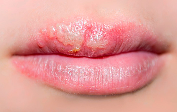 Когда говорят о рецидиве герпеса, то имеют в виду реактивацию уже имеющегося в организме вируса. Когда говорят о рецидиве герпеса, то имеют в виду реактивацию уже имеющегося в организме вируса.