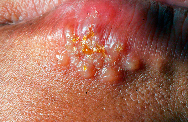 Герпетические пузырьки Герпетические пузырьки