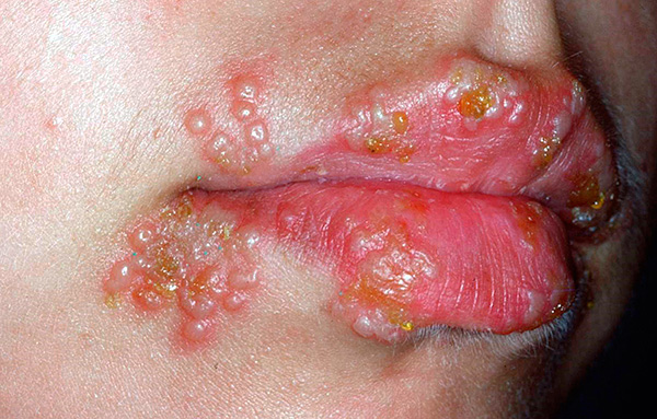 При лабиальном герпесе зачастую поражаются не только губы, но и участки кожи вокруг них. При лабиальном герпесе зачастую поражаются не только губы, но и участки кожи вокруг них.