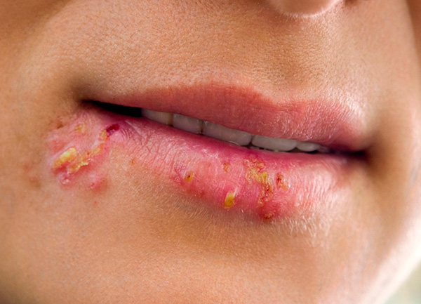 Так выглядит простуда на губах Так выглядит простуда на губах