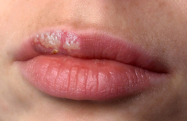 В большинстве случаев витамины минимальным образом влияют на вероятность развития рецидива герпеса. В большинстве случаев витамины минимальным образом влияют на вероятность развития рецидива герпеса.